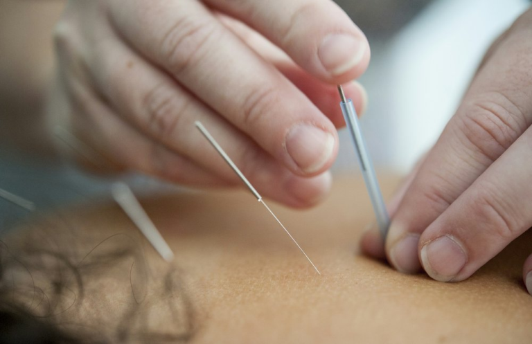 Acupuncture and neuroplasticity at Neuroplasticity St. Pete