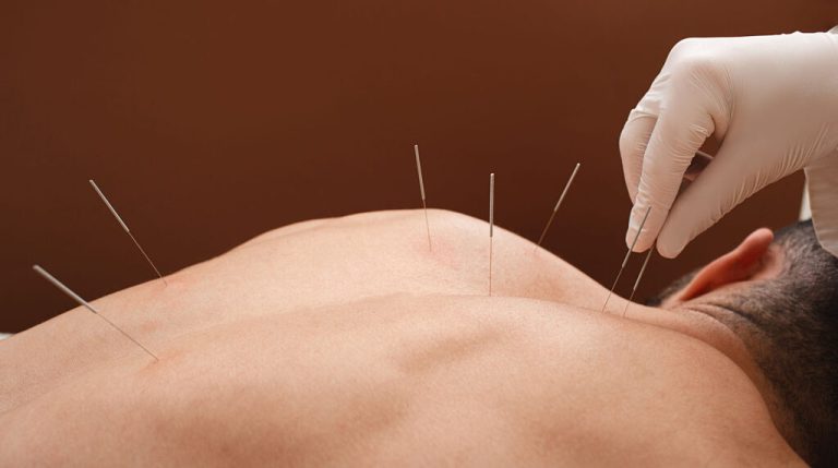 Acupuncture Safety Harbor FL