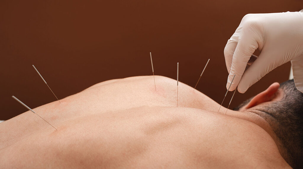 Acupuncture Safety Harbor FL