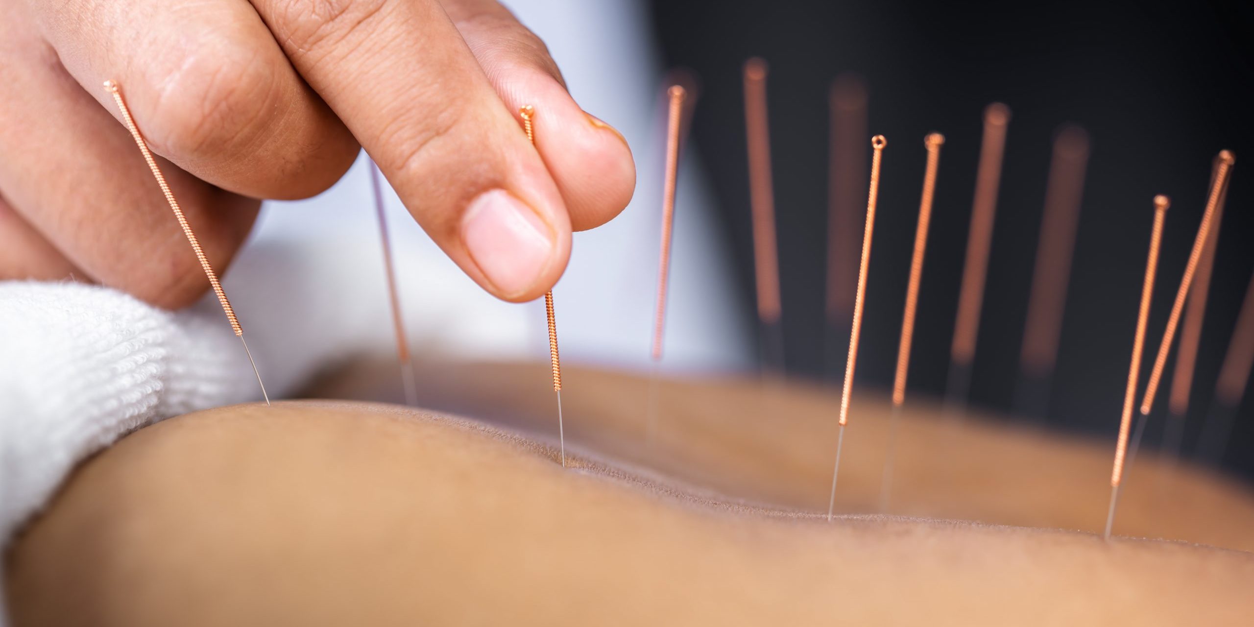 Acupuncture Seminole FL