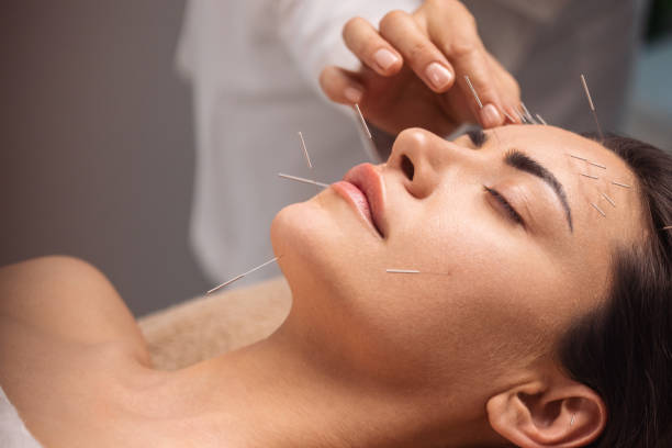 Can Acupuncture for Anxiety Really Help You Feel Better?