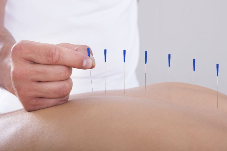 Acupuncture Tarpon Springs FL