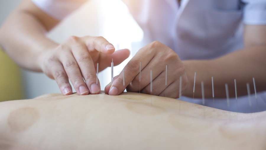Acupuncture Pinellas Park
