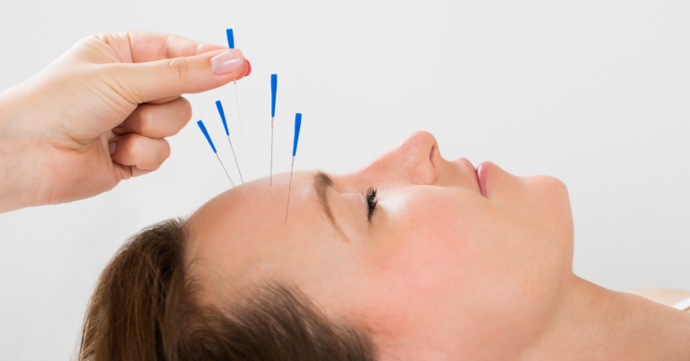 Exploring the Benefits of Acupuncture for Migraines