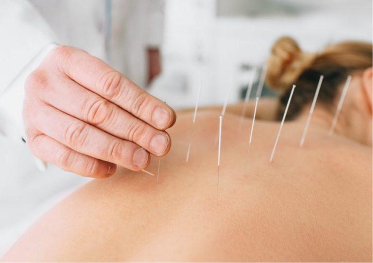 Understanding the Real Benefits of Dry Needling