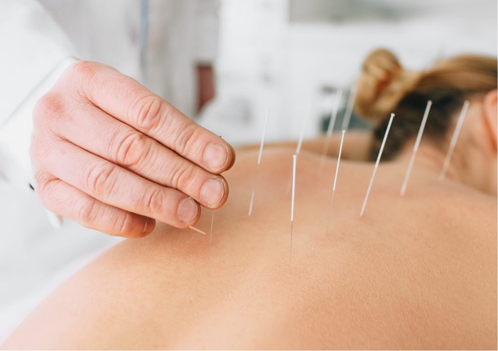 Understanding the Real Benefits of Dry Needling