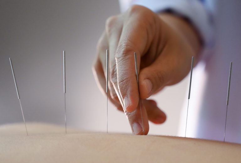 The Ultimate Dry Needling Roadmap for Gulfport Patients