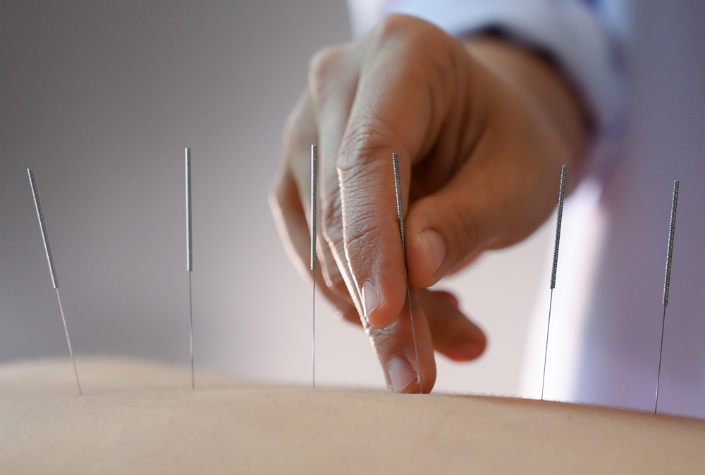 dry needling
