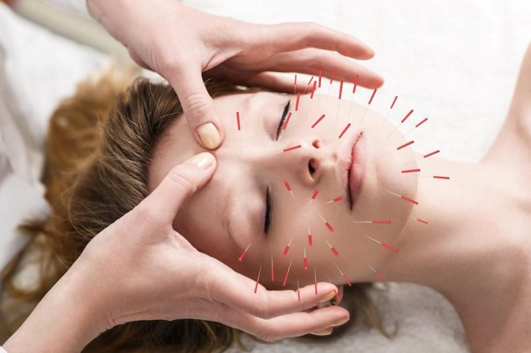 Acupuncture micro-needling treatment at Neuroplasticity St. Pete