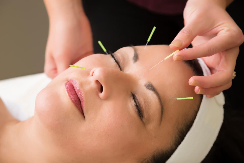 10 Reasons to Try Acupuncture for Stress in Pinellas Park