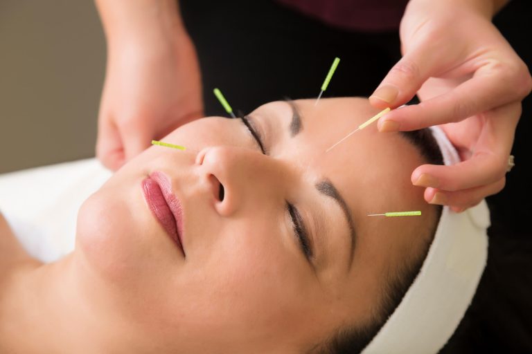 10 Reasons to Try Acupuncture for Stress in Pinellas Park