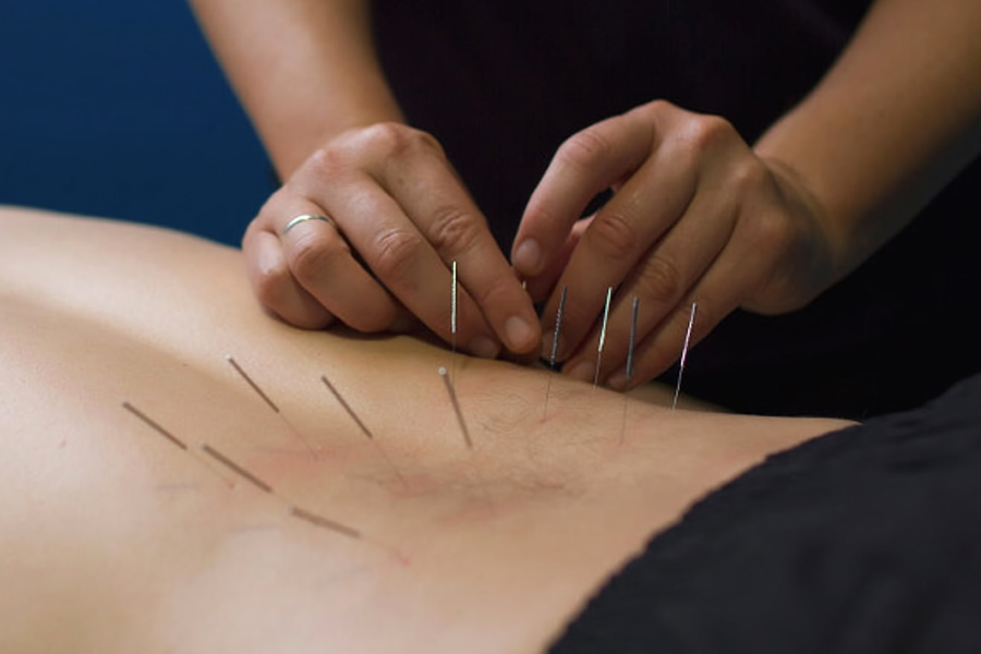 How Dry Needling Therapy Helps Patients in Gulfport FL