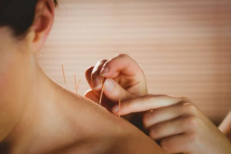 Chinese Acupuncture: Healing for Modern Pain Relief in FL